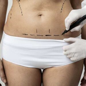 Liposuction-page