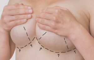 breast lift