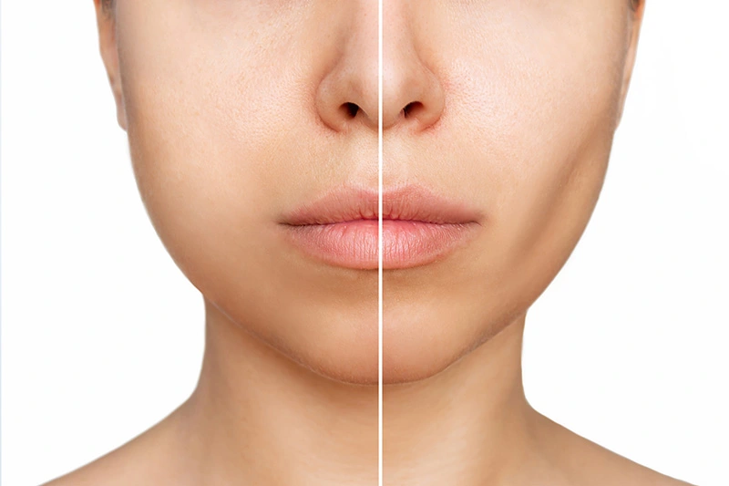 Buccal Fat Removal in Cancun