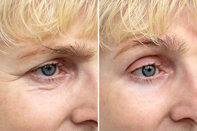 endobrow lift cancun