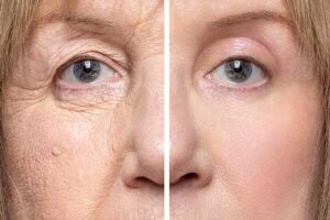 blepharoplasty in Cancun