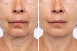 before and after