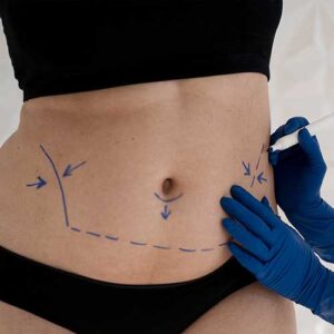 tummy-tuck-procedure